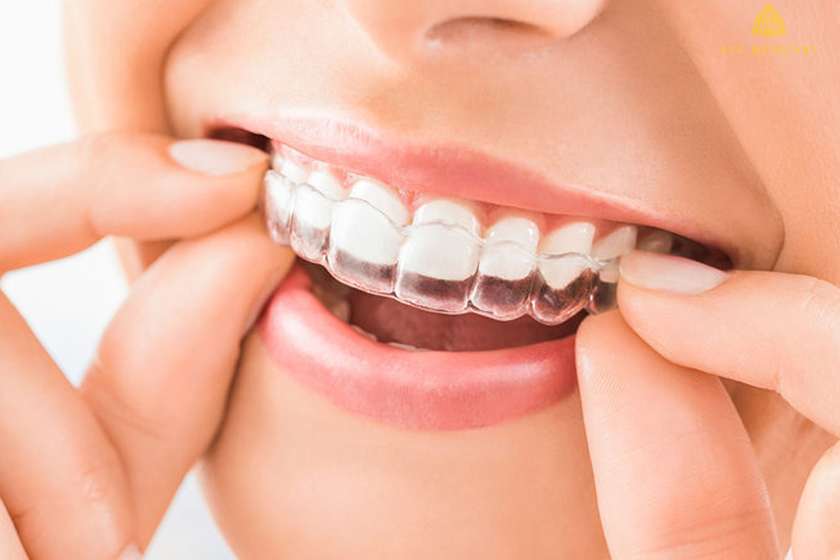 Common Myths About Clear Aligners Debunked